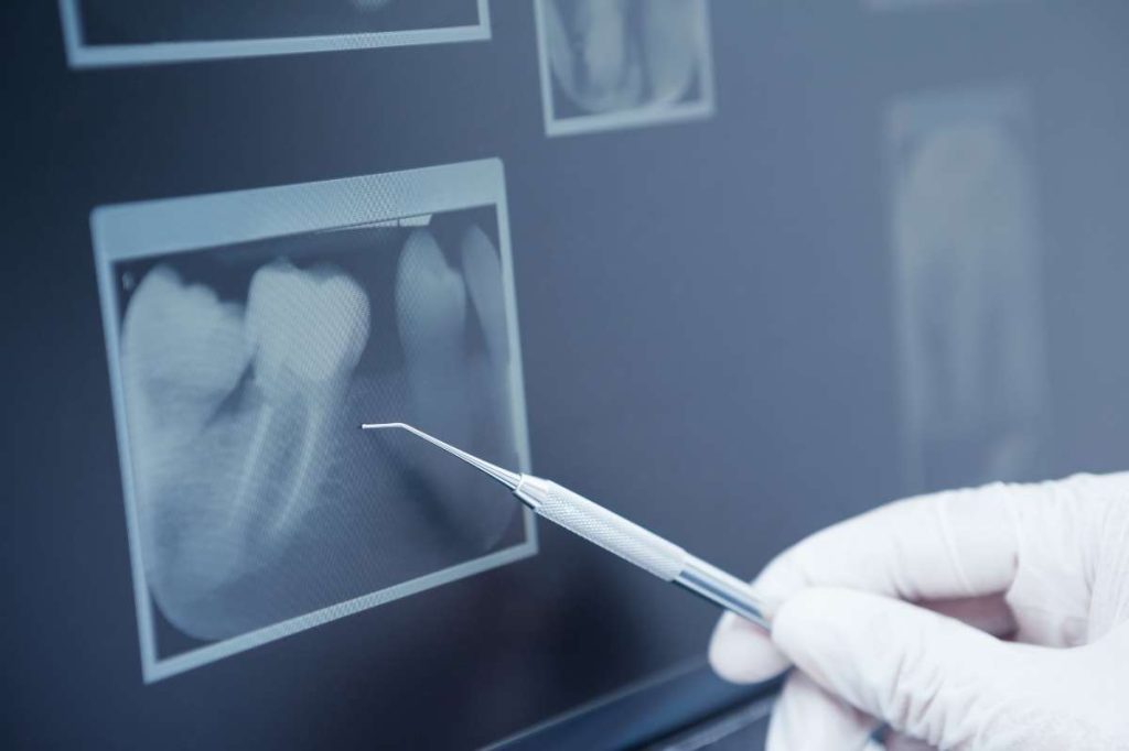Endodonzia: differenze con conservativa