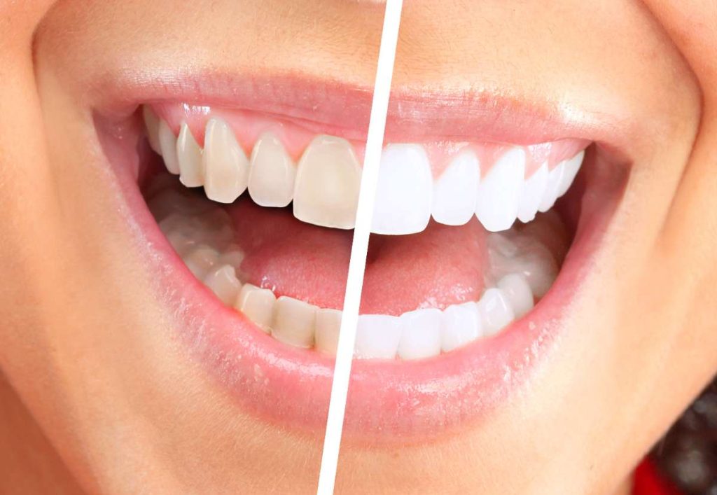 Sbiancamento per avere denti bianchi