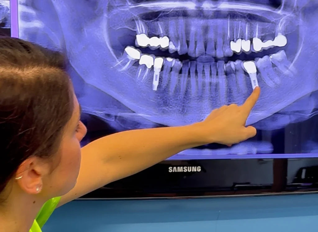 Impianto a carico immediato: cosa significa davvero